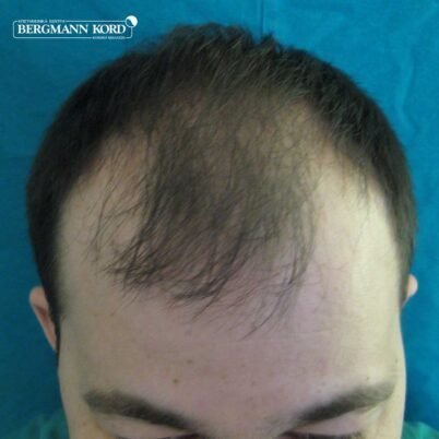 hair-transplantation-bergmann-kord-results-FUT-62017TL-before-top-001