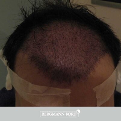 hair-transplantation-bergmann-kord-results-FUT-62017TL-this-day-001