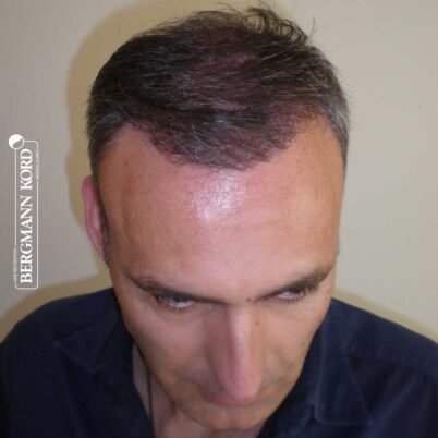 hair-transplantation-bergmann-kord-results-FUT-66029TL-3-months-front-001