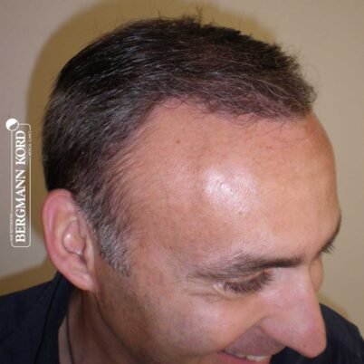 hair-transplantation-bergmann-kord-results-FUT-66029TL-3-months-right-001