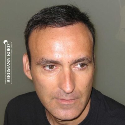 hair-transplantation-bergmann-kord-results-FUT-66029TL-5-months-front-001