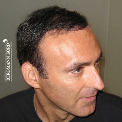 hair-transplantation-bergmann-kord-results-FUT-66029TL-5-months-right-001