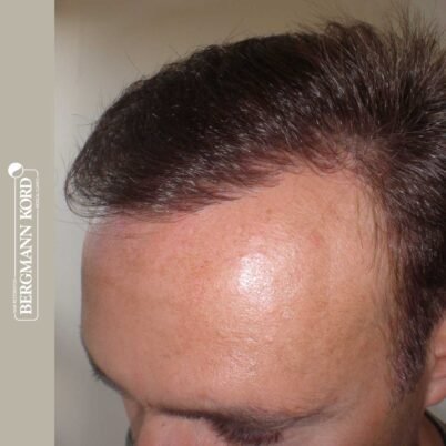 hair-transplantation-bergmann-kord-results-FUT-66029TL-7-months-left-001