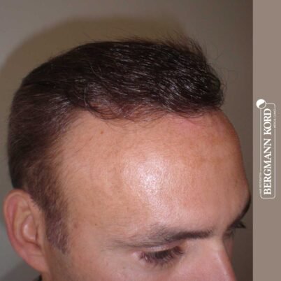 hair-transplantation-bergmann-kord-results-FUT-66029TL-7-months-right-001