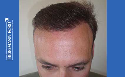 hair-transplantation-bergmann-kord-results-FUT-66029TL-after-001