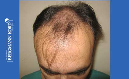 hair-transplantation-bergmann-kord-results-FUT-66029TL-before-001