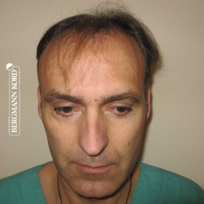 hair-transplantation-bergmann-kord-results-FUT-66029TL-before-front-001