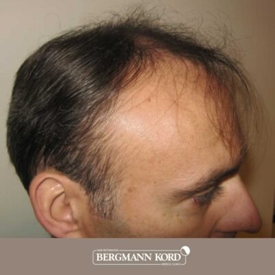 hair-transplantation-bergmann-kord-results-FUT-66029TL-before-left-001