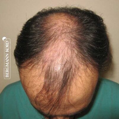 hair-transplantation-bergmann-kord-results-FUT-66029TL-before-top-001