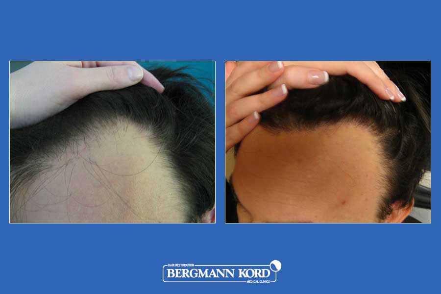 hair-transplantation-bergmann-kord-results-men-11099PG-before-after-002
