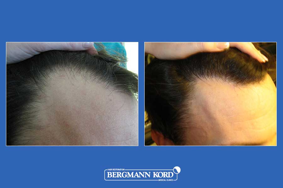 hair-transplantation-bergmann-kord-results-men-11099PG-before-after-003