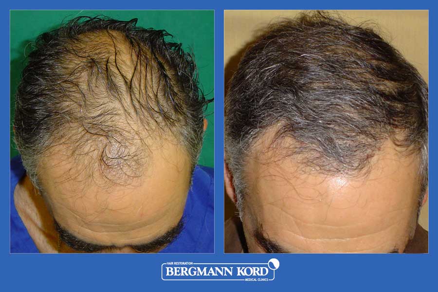 hair-transplantation-bergmann-kord-results-men-19089PG-before-after-002