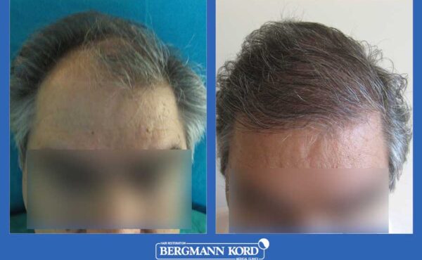 hair-transplantation-bergmann-kord-results-men-20089PG-001