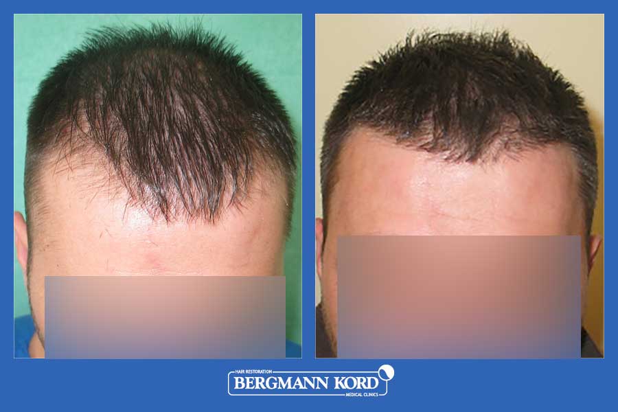 hair-transplantation-bergmann-kord-results-men-20291PG-before-after-001