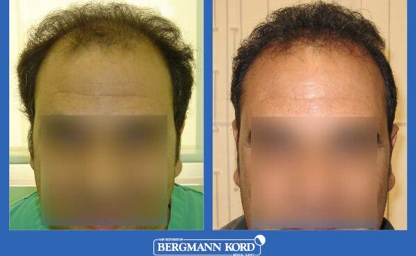 hair-transplantation-bergmann-kord-results-men-21366PG-before-after-001