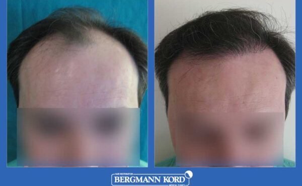 hair-transplantation-bergmann-kord-results-men-22078PG-before-after-001
