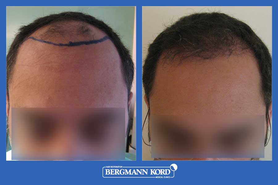 hair-transplantation-bergmann-kord-results-men-22320PG-before-after-001