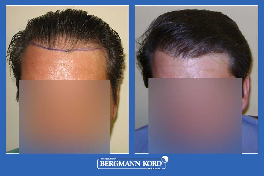 hair-transplantation-bergmann-kord-results-men-22334PG-before-after-001