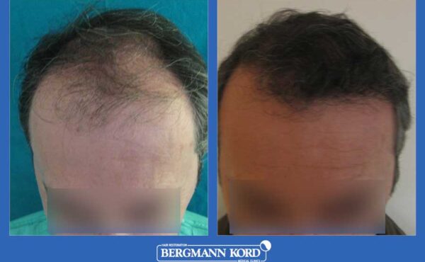 hair-transplantation-bergmann-kord-results-men-23210PG-before-after-001