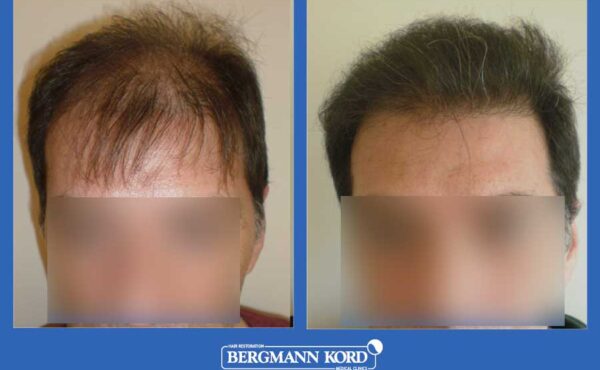 hair-transplantation-bergmann-kord-results-men-23501PG-before-after-001