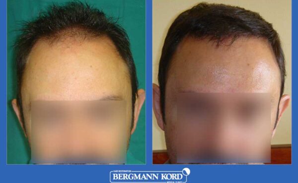 hair-transplantation-bergmann-kord-results-men-24313PG-before-after-001