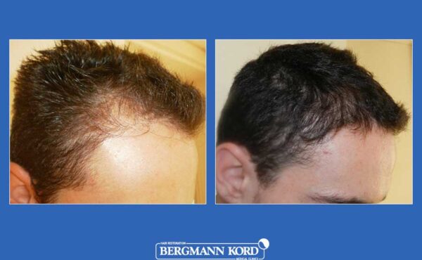 hair-transplantation-bergmann-kord-results-men-24567PG-before-after-001