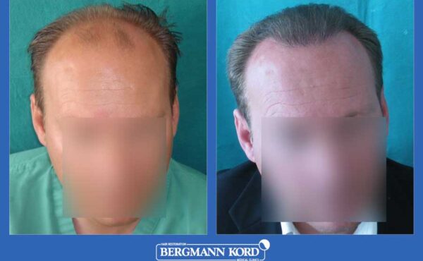 hair-transplantation-bergmann-kord-results-men-24800PG-before-after-001
