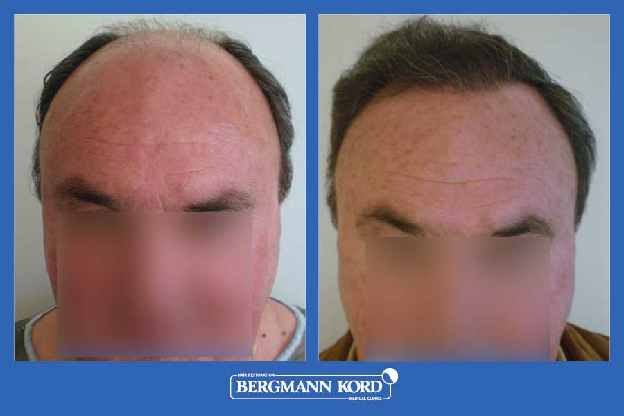 hair-transplantation-bergmann-kord-results-men-25029PG-before-after-001