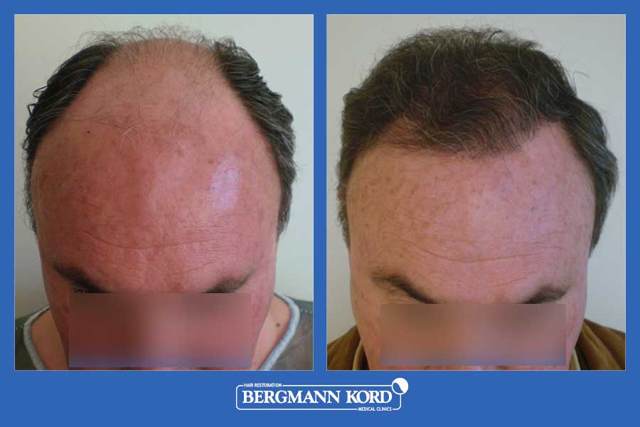 hair-transplantation-bergmann-kord-results-men-25029PG-before-after-002