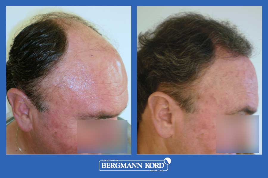 hair-transplantation-bergmann-kord-results-men-25029PG-before-after-004