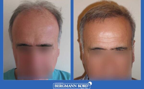 hair-transplantation-bergmann-kord-results-men-25067PG-before-after-001