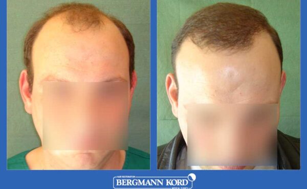 hair-transplantation-bergmann-kord-results-men-26095PG-before-after-001
