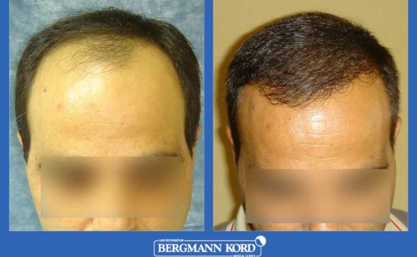 hair-transplantation-bergmann-kord-results-men-26099PG-before-after-001