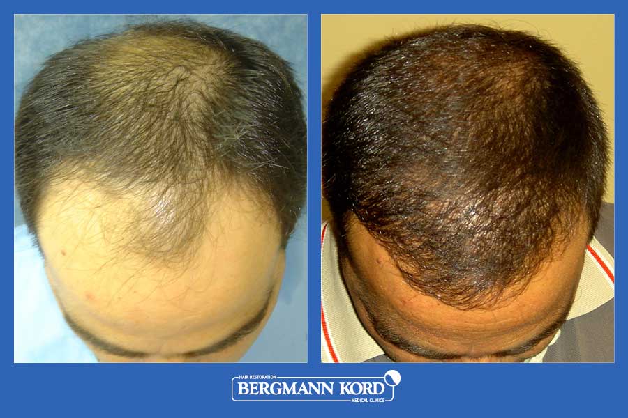 hair-transplantation-bergmann-kord-results-men-26099PG-before-after-002