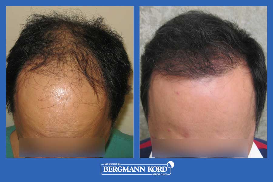 hair-transplantation-bergmann-kord-results-men-26308PG-before-after-001