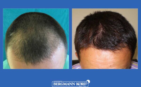 hair-transplantation-bergmann-kord-results-men-27001PG-before-after-001