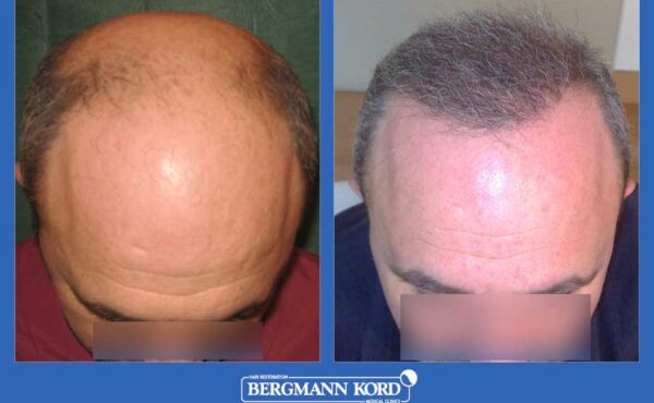 hair-transplantation-bergmann-kord-results-men-27689PG-before-after-001