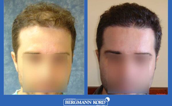 hair-transplantation-bergmann-kord-results-men-28073PG-before-after-001