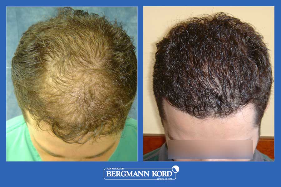 hair-transplantation-bergmann-kord-results-men-28073PG-before-after-002