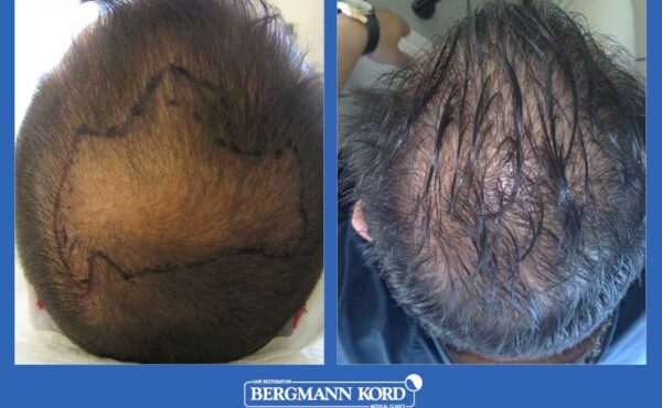 hair-transplantation-bergmann-kord-results-men-28101PG-before-after-001