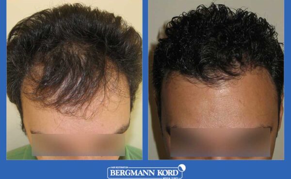 hair-transplantation-bergmann-kord-results-men-29508PG-before-after-001