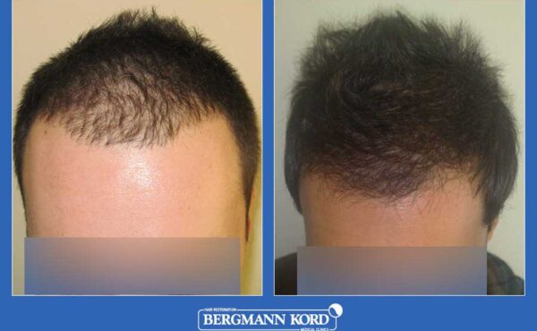 hair-transplantation-bergmann-kord-results-men-29871PG-before-after-001