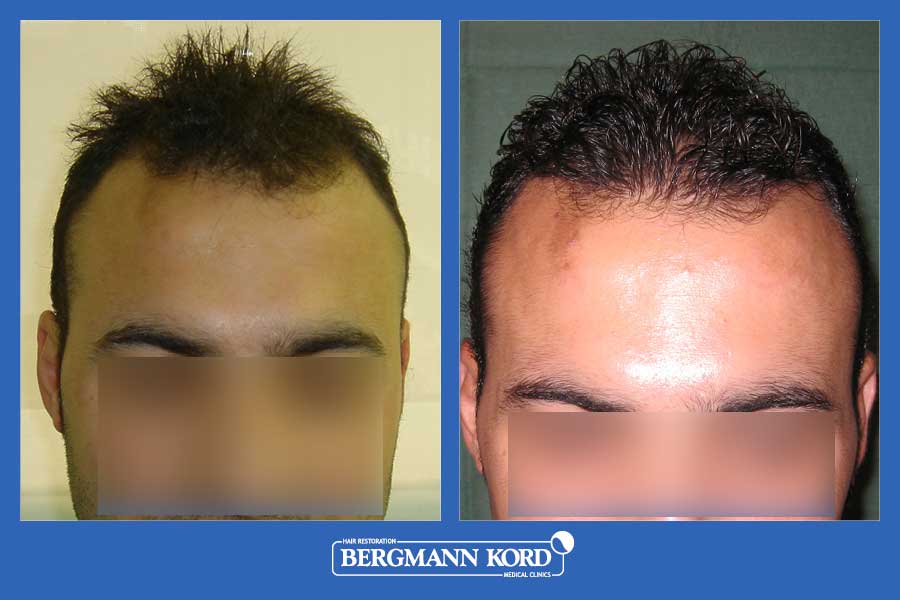 hair-transplantation-bergmann-kord-results-men-30098PG-before-after-001