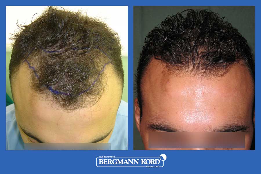 hair-transplantation-bergmann-kord-results-men-30098PG-before-after-002