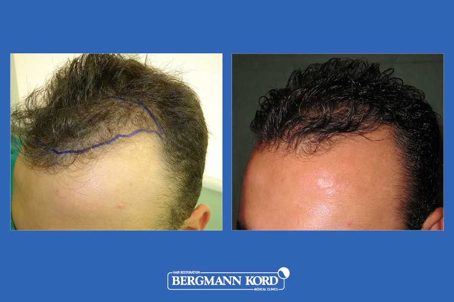 hair-transplantation-bergmann-kord-results-men-30098PG-before-after-004
