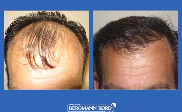 hair-transplantation-bergmann-kord-results-men-31092PG-before-after-001