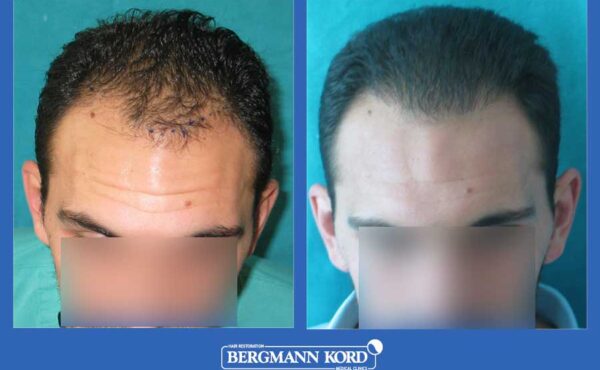 hair-transplantation-bergmann-kord-results-men-31667PG-before-after-001