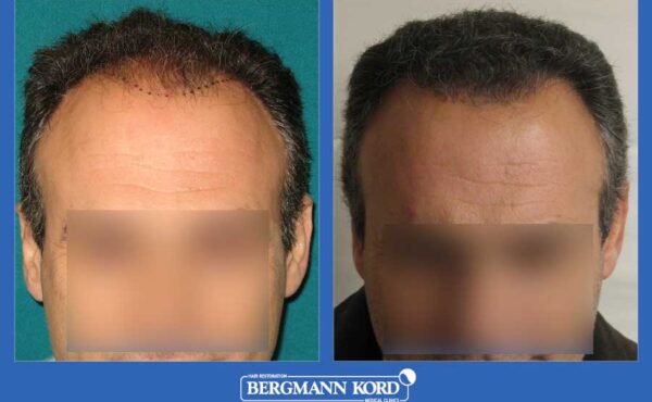 hair-transplantation-bergmann-kord-results-men-32284PG-before-after-001