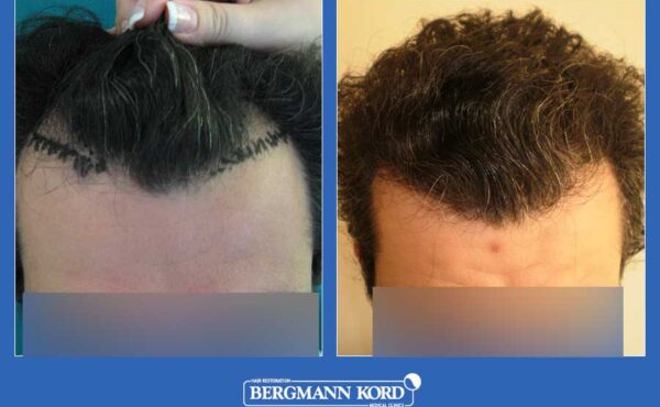 hair-transplantation-bergmann-kord-results-men-33033PG-before-after-001