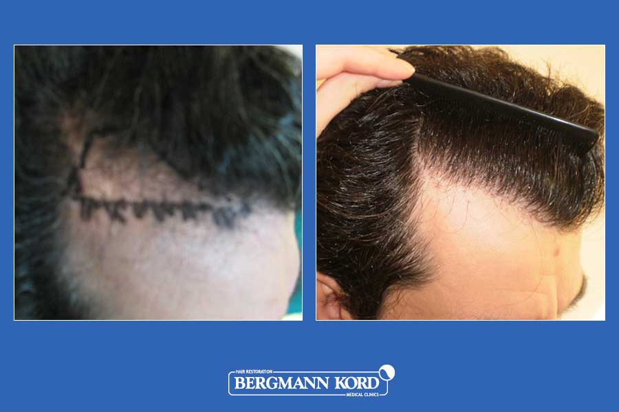 hair-transplantation-bergmann-kord-results-men-33033PG-before-after-002